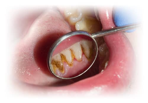 Zahnbelag-Zahnstein-Zahnverfaerbungen