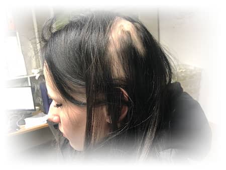 Alopecia-Areata