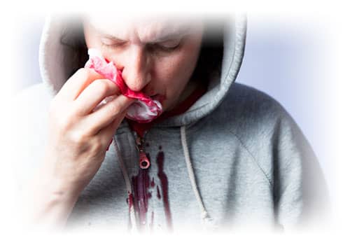 Nasenbluten-Epistaxis